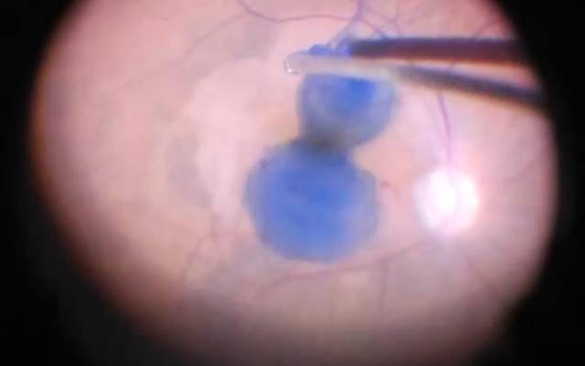 首例ILM-BLUE術中應用照片：染色效果良好，囊膜邊界清晰。